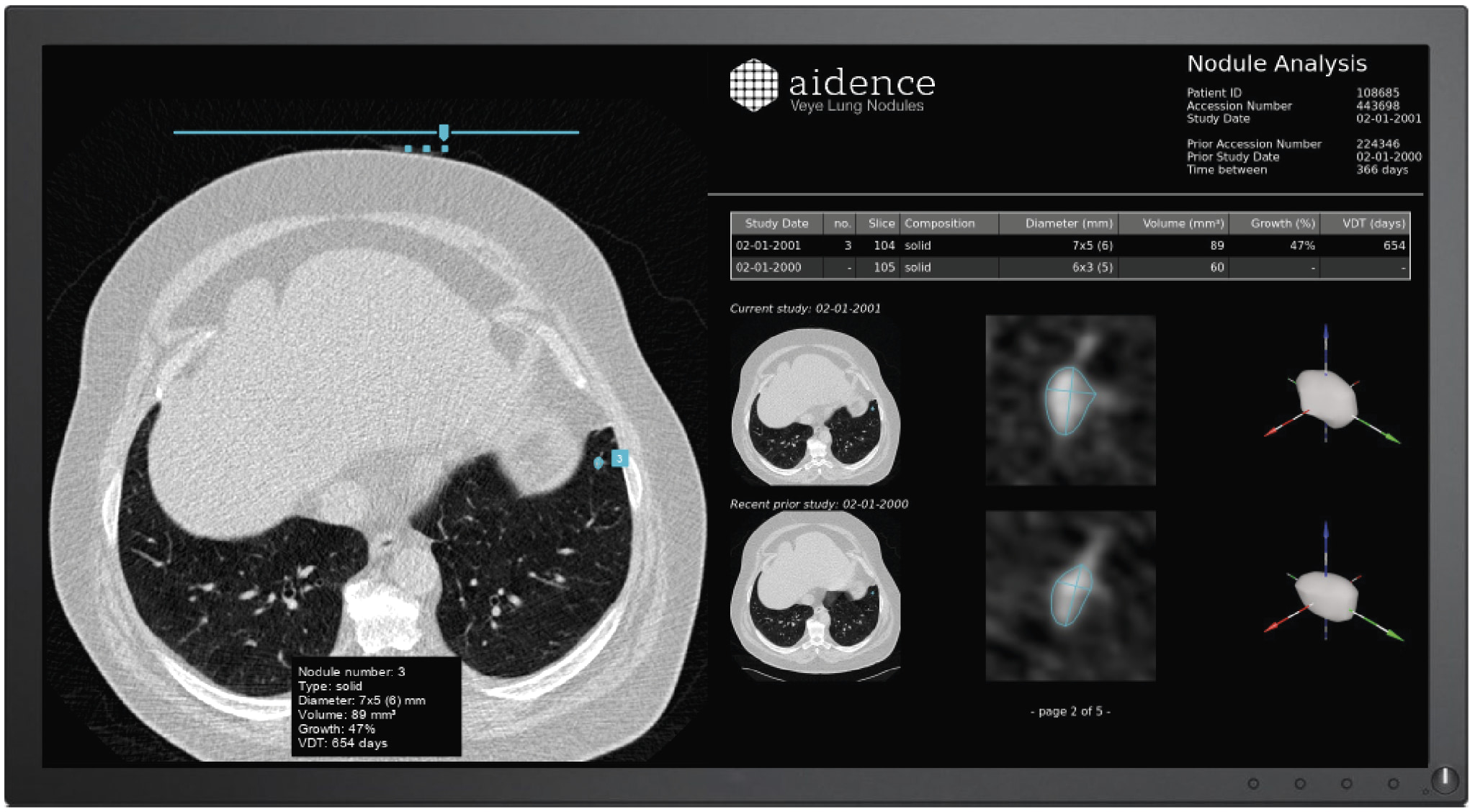 El sistema de Aidence ayuda a detectar, medir, clasificar y seguir el crecimiento de los nódulos pulmonares - Imagen de Veye Lung Nodules.