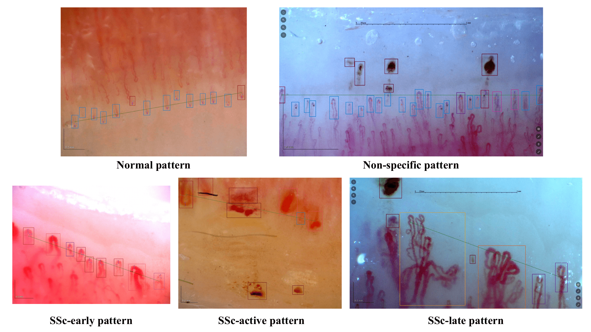 Ejemplos de patrones capilaroscópicos.