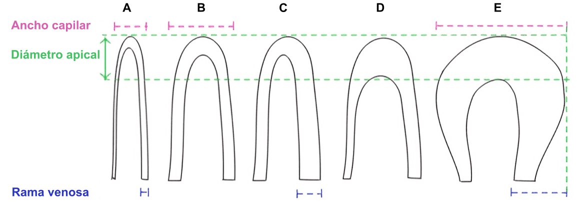 Morfología de los capilares: (A) bucle capilar normal, (B) bucle capilar con dilatación aferente, (C) bucle capilar con dilatación eferente, (D) bucle capilar dilatado y (E) bucle capilar gigante en forma de herradura. Fuente: Capilaroscopia periungueal en las enfermedades reumáticas: ¿Qué parámetros deben evaluarse?