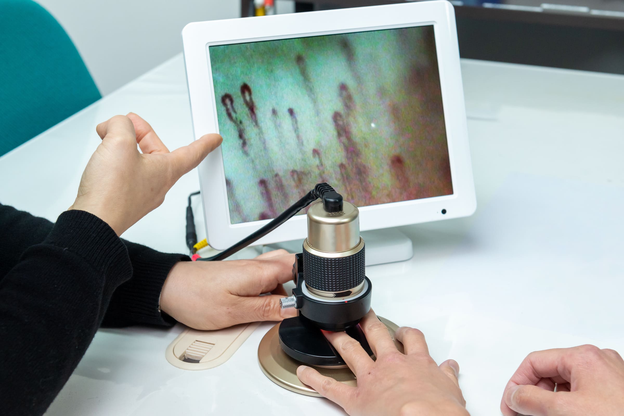 Procedimiento de capilaroscopia - El médico examina el lecho ungueal del paciente con un microscopio