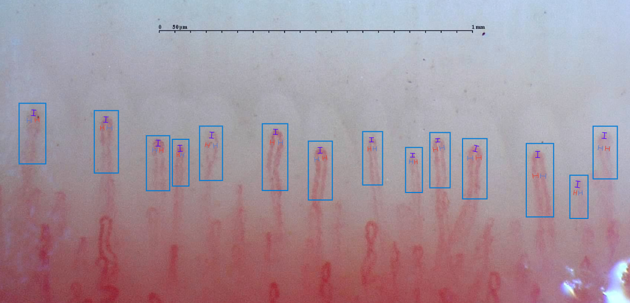 Ejemplo de capilaroscopia en el que se observan capilares normales