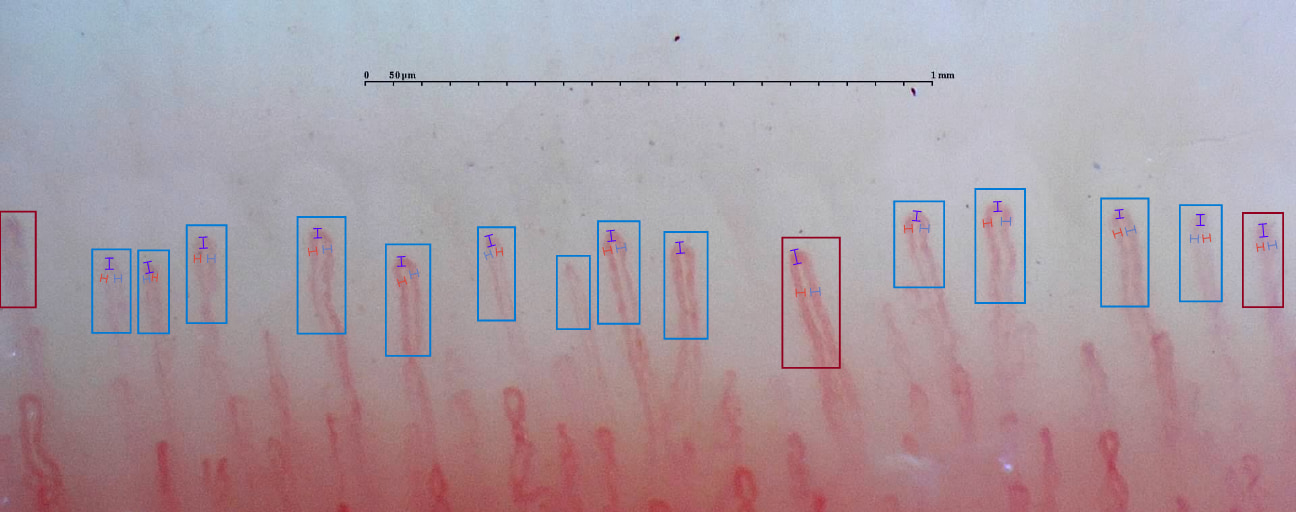 Ejemplo de capilaroscopia en el que pueden observarse capilares normales