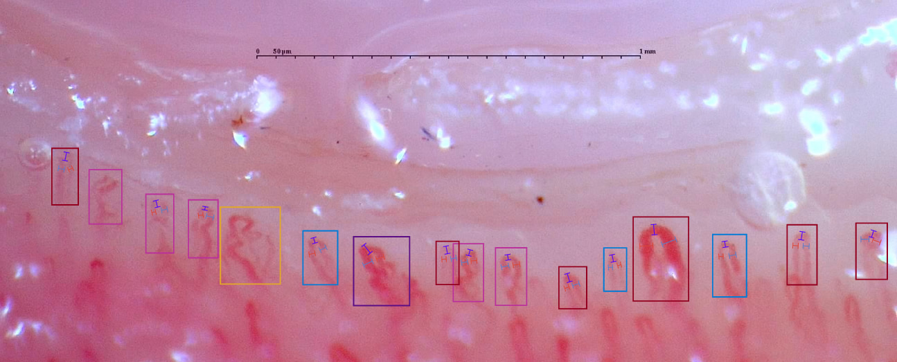 Ejemplo de capilaroscopia en el que pueden observarse algunas alteraciones