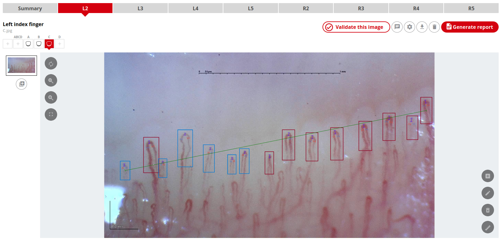 El sistema de Capillary.io automatiza la detección, medición y clasificación de los capilares en todas las imágenes de capilares del lecho ungueal.
