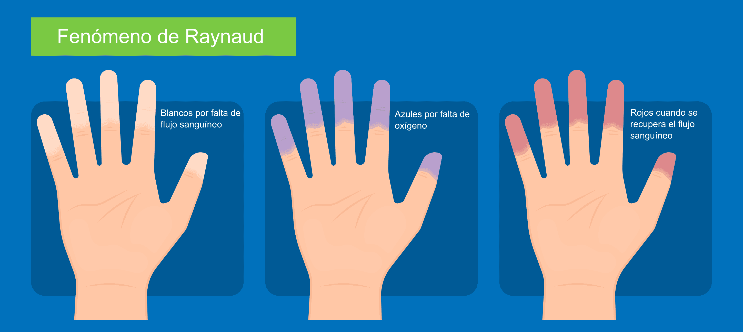Fenómeno de Raynaud: cambios de color en los dedos