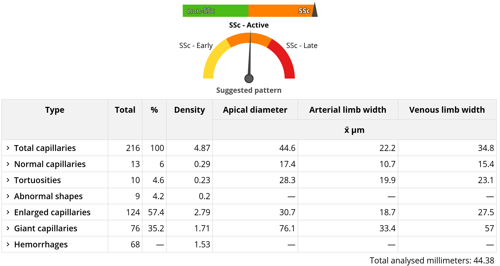 Sugerencia de patrón de esclerodermia en Capillary.io con densidad capilar, capilares gigantes, hemorragias y morfología