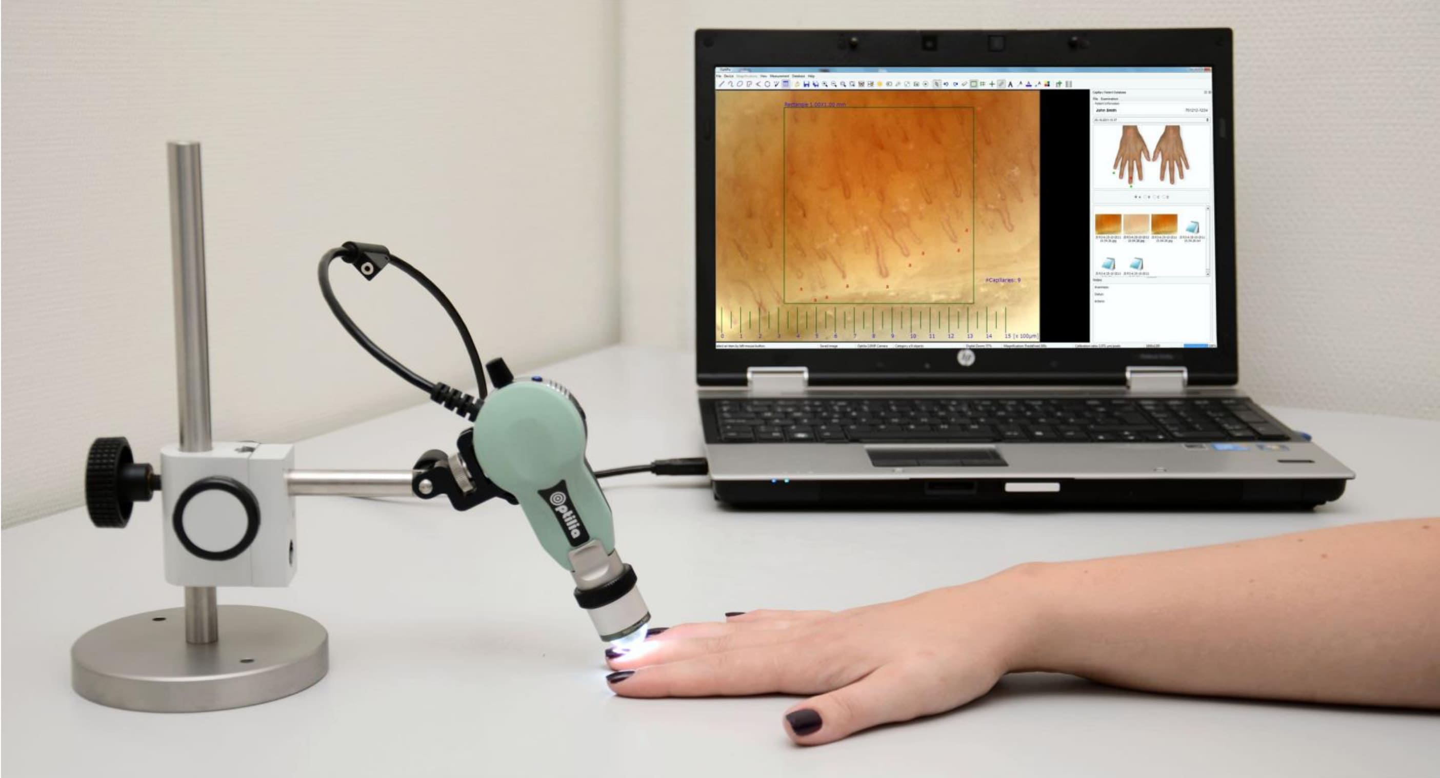 Procedimiento de capilaroscopia: se observan los capilares de la base de las uñas mediante un microscopio USB portátil conectado al ordenador